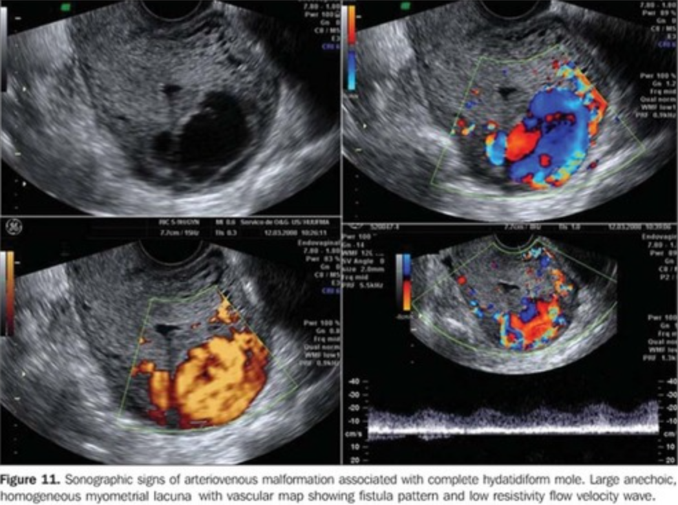 <p>Uterine arteriovenous malformations consist of a ____ ____ of arteries and veins without an intervening ______ network </p>