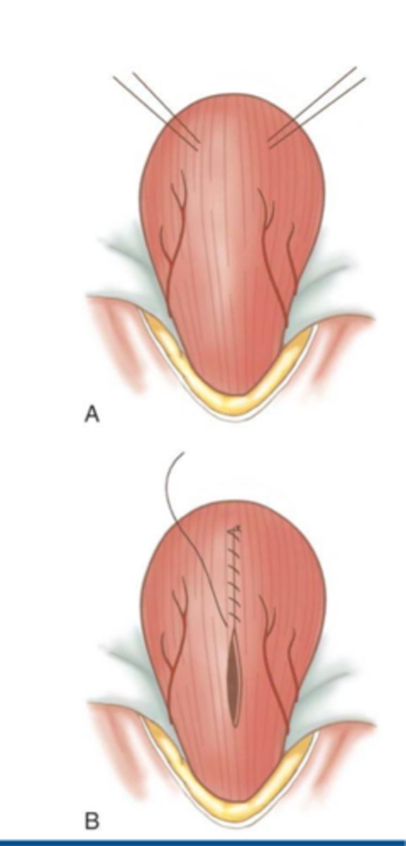 <p>what procedure is shown here</p>