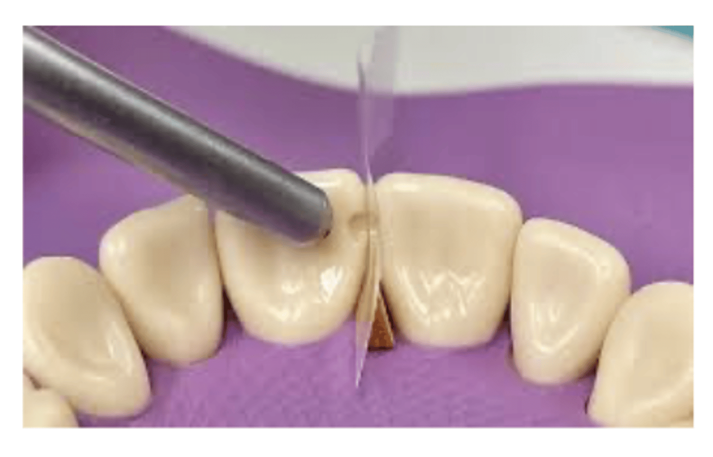 <p>Composite restorations</p><p>Class III and IV restorations (anterior teeth)</p>
