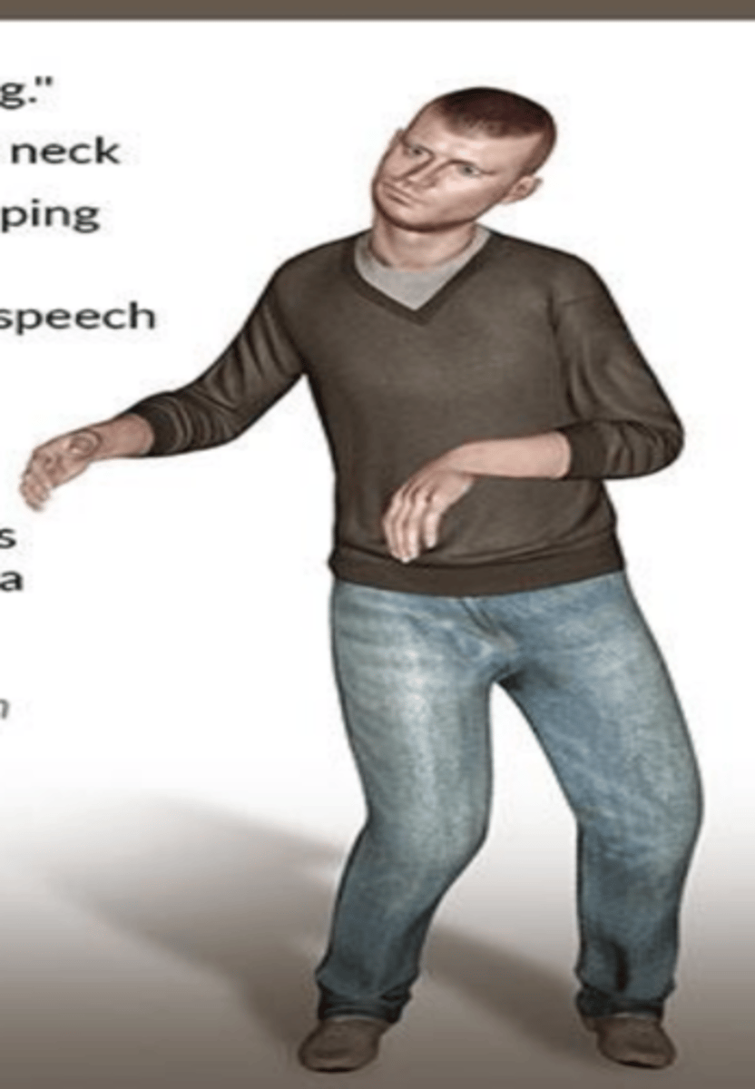 <p>-TREMOR (described as pill rolling)</p><p>-rigidity (no swinging muscles, soreness)</p><p>-dystonia (a sustained muscle contraction resulting in abnormal posturing)</p>