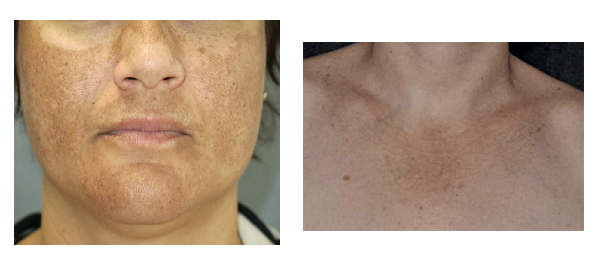 <p>What characterizes <strong>melasma</strong>?</p>