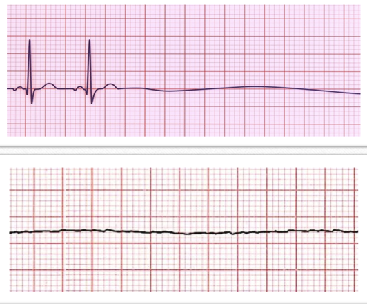 <ul><li><p class=""><strong>Rate:</strong> No pulse</p></li><li><p class=""><strong>Rhythm:</strong> No rhythm (flatline)</p></li><li><p class=""><strong>P Waves:</strong> Absent</p></li><li><p class=""><strong>PR Interval:</strong> Not applicable</p></li><li><p class=""><strong>QRS Complex:</strong> Absent</p></li><li><p class=""><strong>Key Feature:</strong> <strong>NO PULSE! – Cardiac Arrest</strong></p></li></ul><p>**non-shockable rhythm</p>