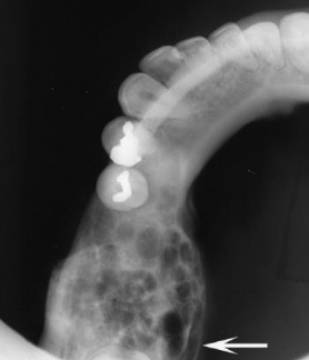 <p>Ameloblastoma</p>