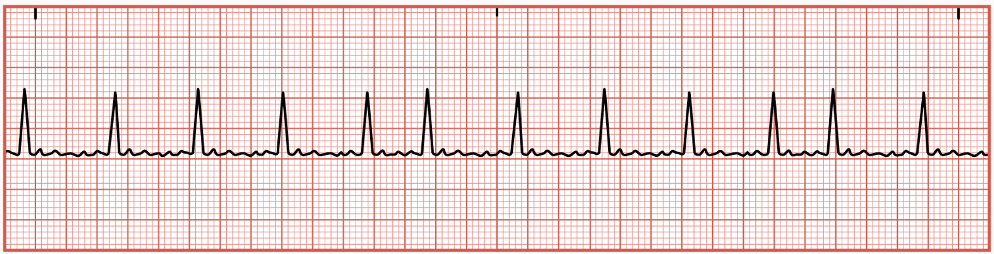 <p>occurs when the SA node is not firing appropriately</p><ul><li><p>electrical impulses are rapid, chaotic, and irregular</p></li><li><p>blood clots can form&nbsp;</p></li></ul><p></p>