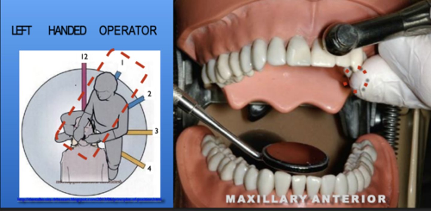 <p>Zone: 1</p><p>Vision: Direct</p><p>Patient's Head: Center</p><p>Fulcrum: Max Left Premolars (O) or Incisors (I)</p>