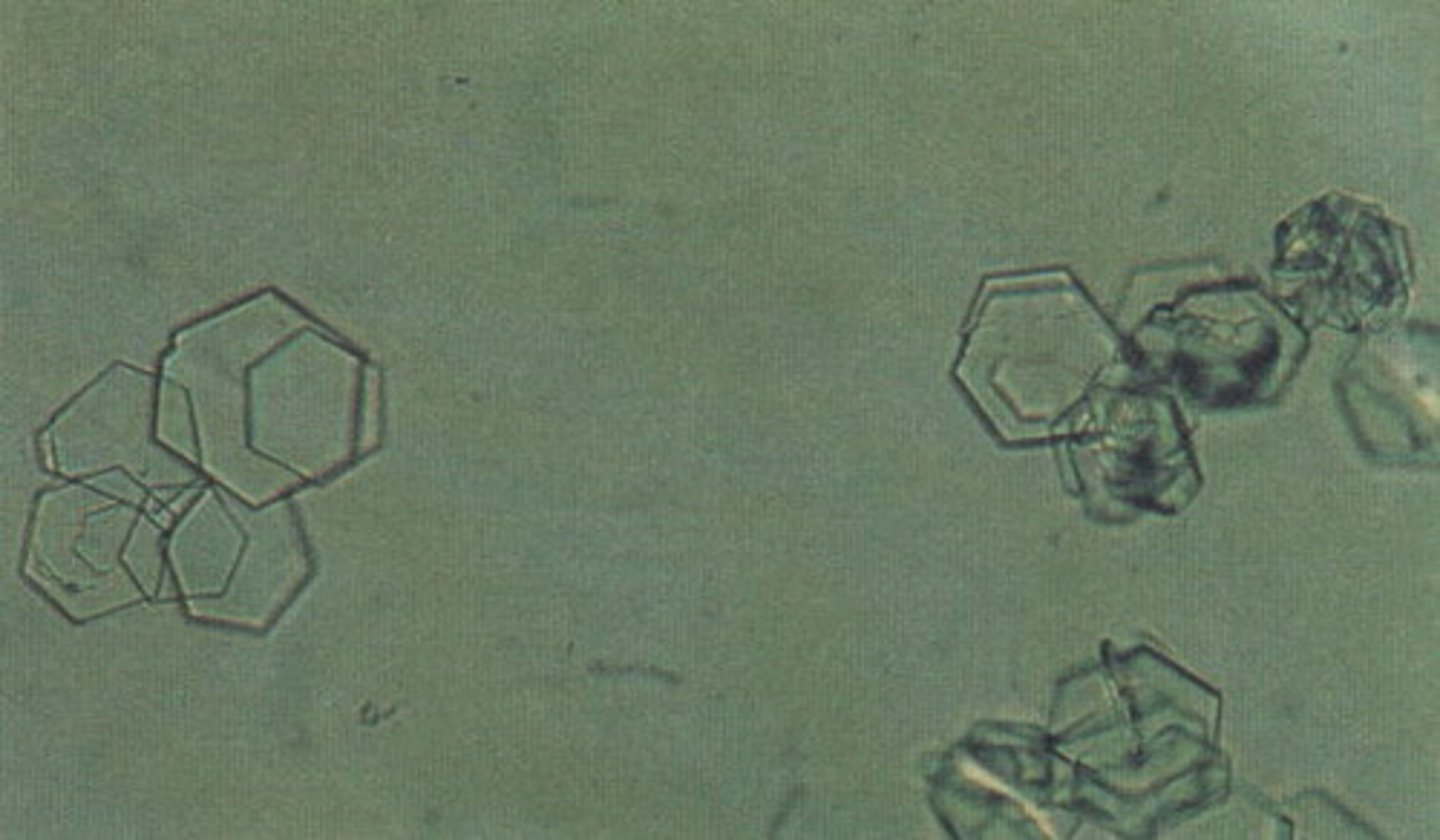 <p>-very abnormal</p><p>-hexagonal plates with uneven sides</p>