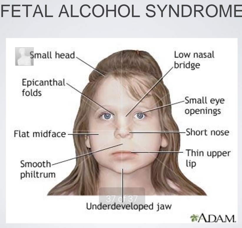 <ul><li><p> facial deformities, failure to smooth</p></li></ul>