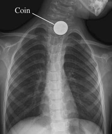 <p>Aspiration/Foreign Body</p>