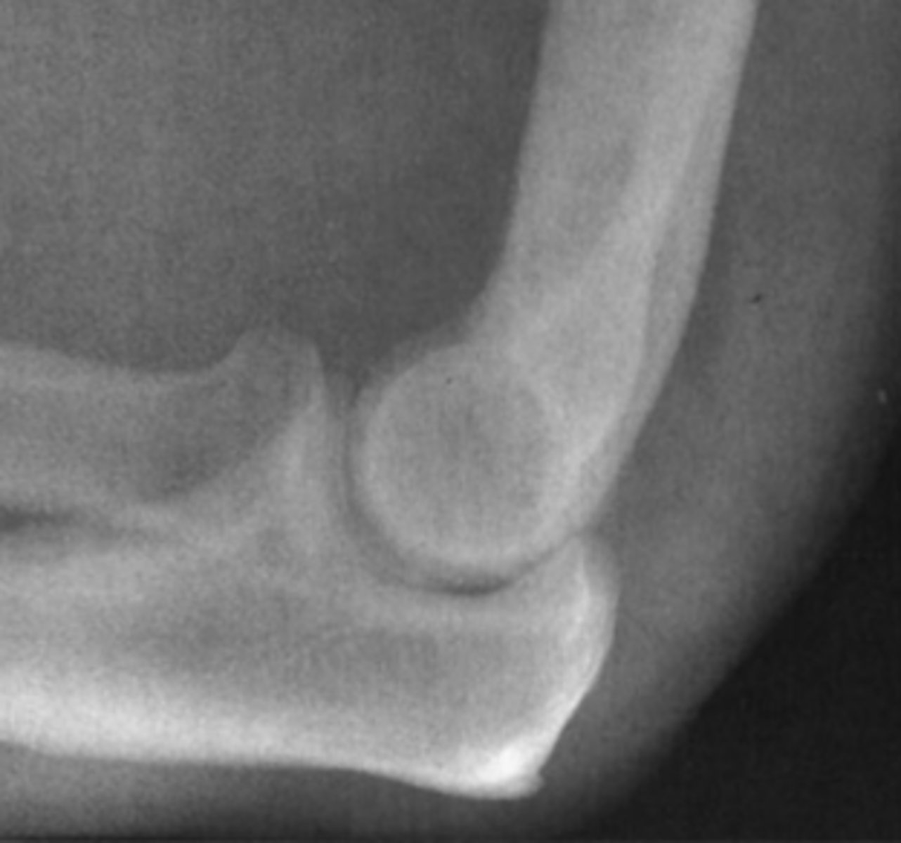 <p>You first examine the lateral view of the elbow in Case</p><p>6-3 (Figure 6-10). You find</p><p>A. a lytic lesion in the distal humerus.</p><p>B. displacement of the fat pads of the elbow.</p><p>C. a fracture through the proximal ulna.</p><p>D. dislocation of the elbow.</p>