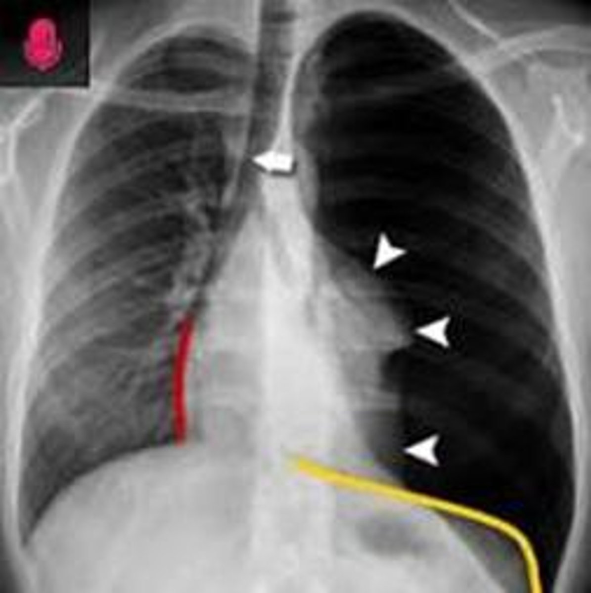 <p>Sudden dyspnea, tachypnea, chest pain, absent breath sounds on the affected side, and crepitus.</p>