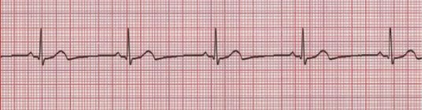 <p>What does this EKG show?</p>