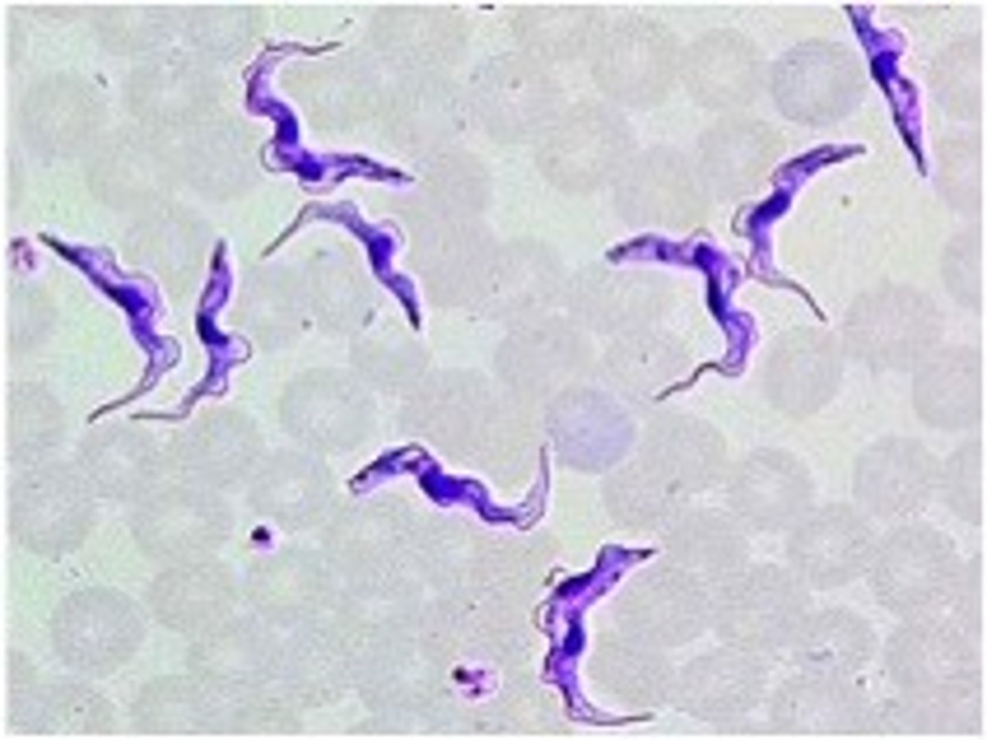 <p>Define CNS Infection Cause:</p><p>African sleeping sickness</p><p>-Spread by the bite of the tsetse fly</p><p>-May be seen with Chagas' disease (serious cardiomyopathy)</p>