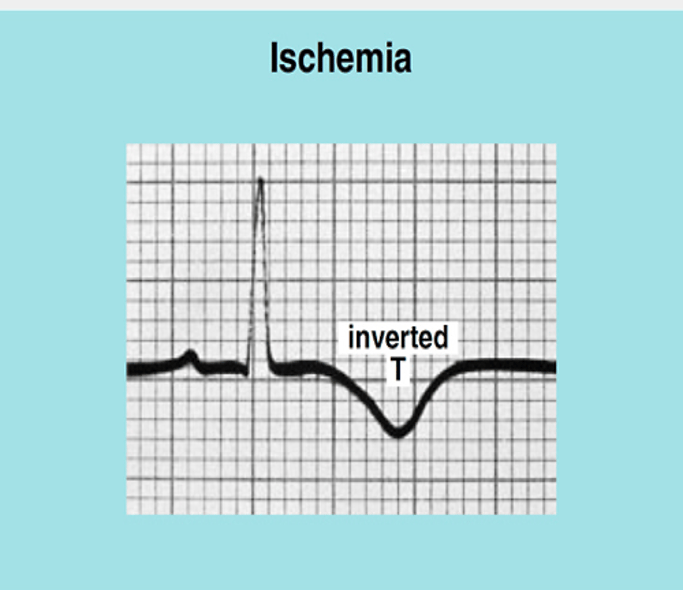 <p>- T waves that flip from normal upright position</p><p>- indicative of ischemia if at least 1 mm deep</p>