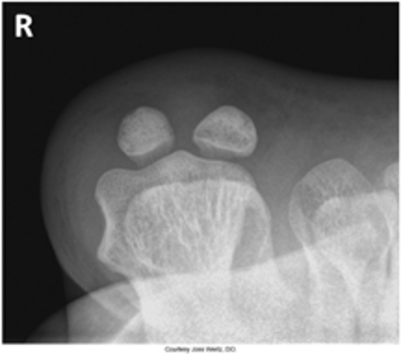 <p>- Sesamoids free of superimposition</p><p>- Minimum of three metatarsals seen</p><p>- Optimal exposure factors</p>