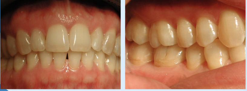 <p>It is where the teeth have the most contact and your jaw is in a comfortable, stable position</p><p>“the best fit” of your teeth when you bite down</p>