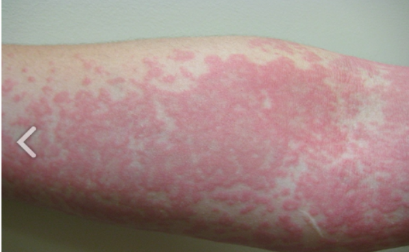 <ol><li><p>allergic reaction</p></li><li><p>idiopathic overall </p></li><li><p>emotional stress</p></li><li><p>extreme exposure to cold or sun </p></li><li><p>illness</p></li><li><p>infections </p><p></p></li></ol><p>superficial dermal swelling aka wheals/welts that are pruitic and pink/pale in center</p><p>(itchy, raised, red or skin-colored welts that sudden appear) </p>