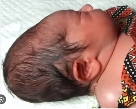 <p>What condition is localized SC edema over the occipitoparietal region &amp; distention of capillaries and extravasation of blood and fluid from the vacuum effect of the rupture of amniotic sac?</p>