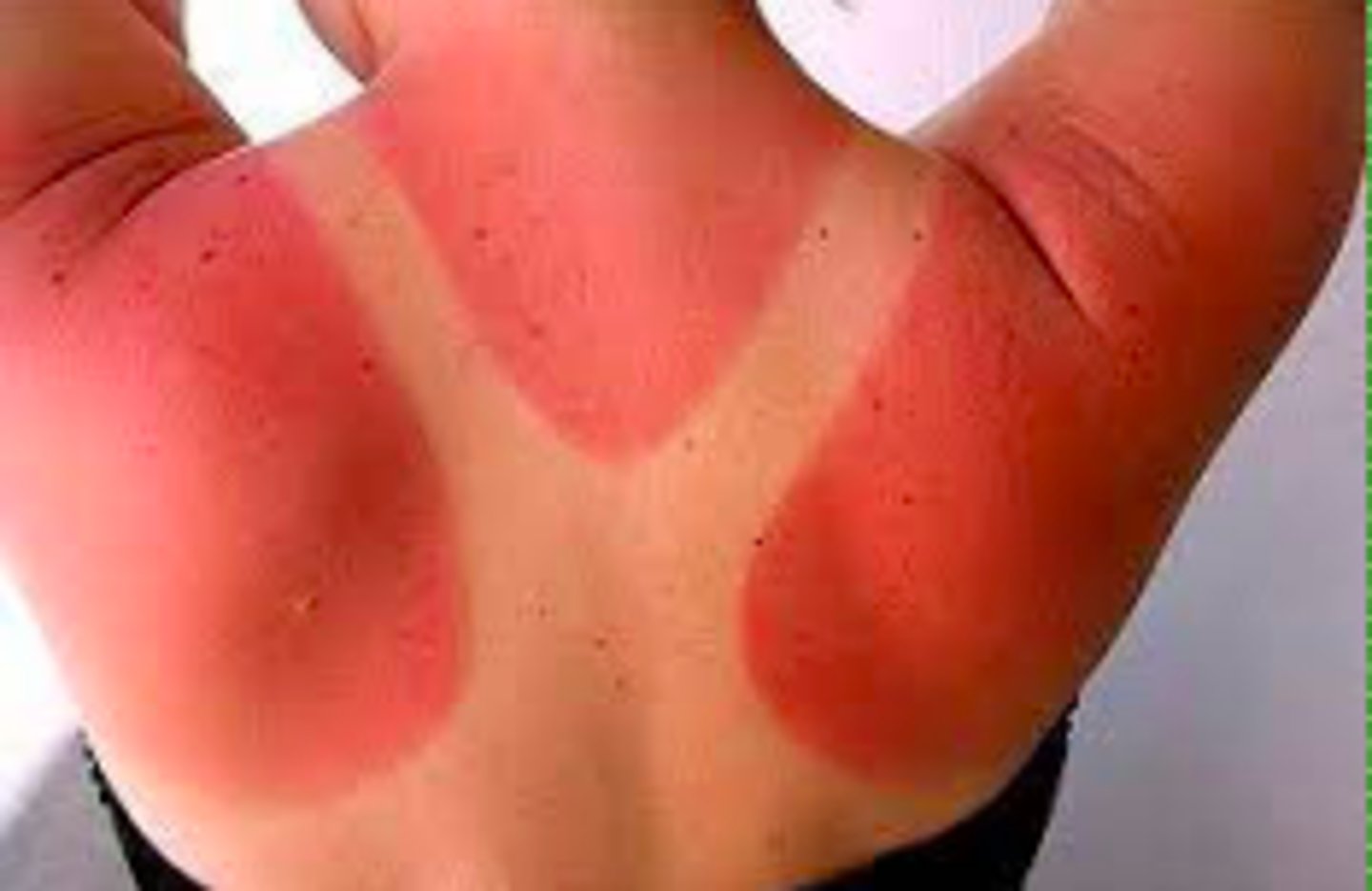 <p>burns through the epidermis</p><p>skin is red and painful but no blisters (sun burn)</p>