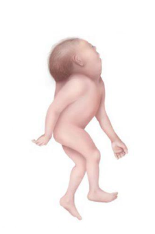 <ul><li><p>Failure of normal closure and segmentation of:</p><ul><li><p class="p1"><strong><mark data-color="yellow" style="background-color: yellow; color: inherit;">Upper neural tube</mark></strong></p></li><li><p class="p1"><strong><mark data-color="yellow" style="background-color: yellow; color: inherit;">Cervical vertebrae</mark></strong></p></li></ul></li><li><p class="p1">Occurs during weeks 3–4 of gestation</p></li></ul><p></p>