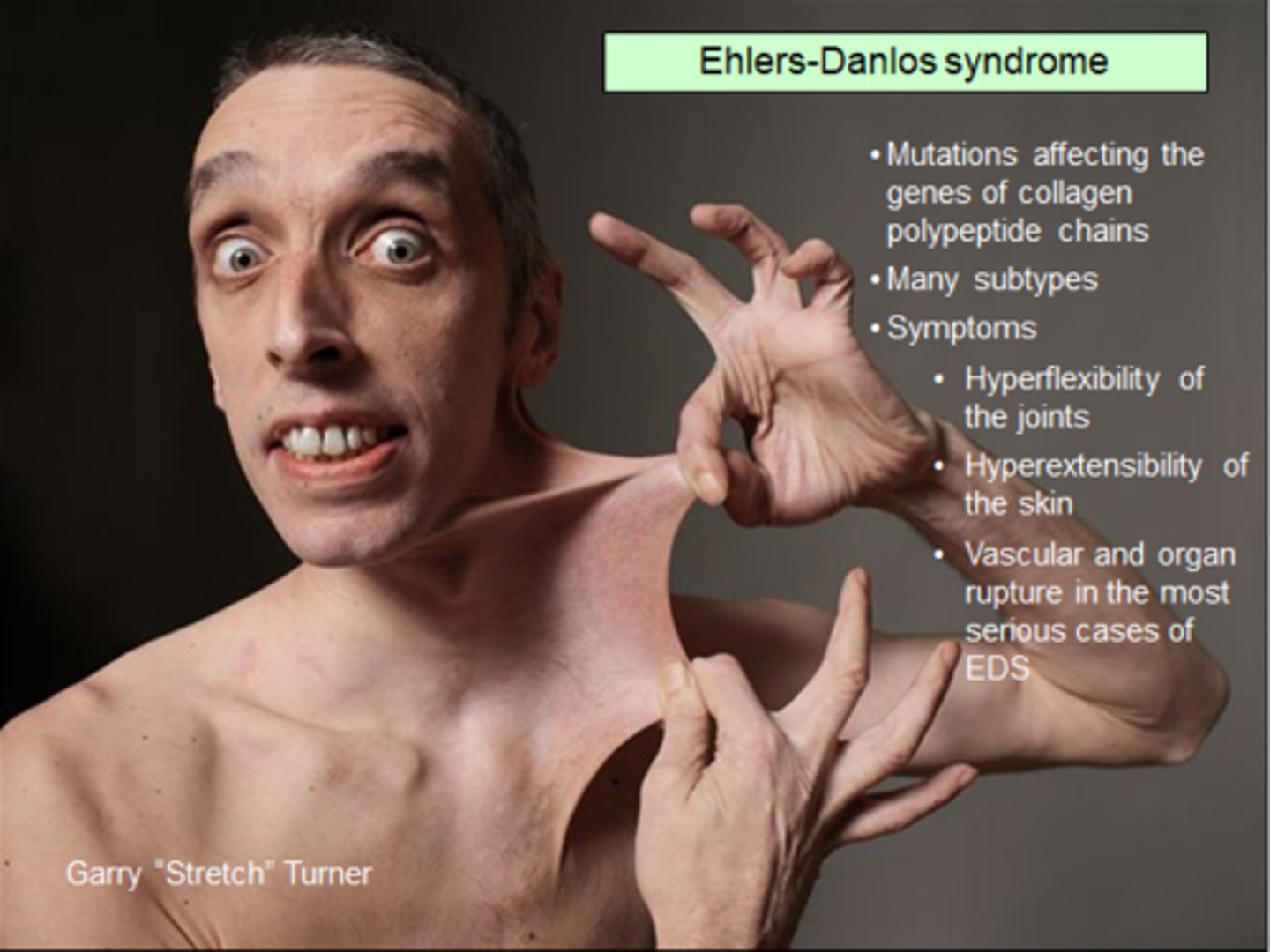 <p>connective tissue disorder caused by defects in the structure, production, or processing of fibrillar collagen</p><p>- skin is not properly bound to bone!</p>