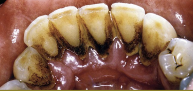 <p>Brown Stains:</p>