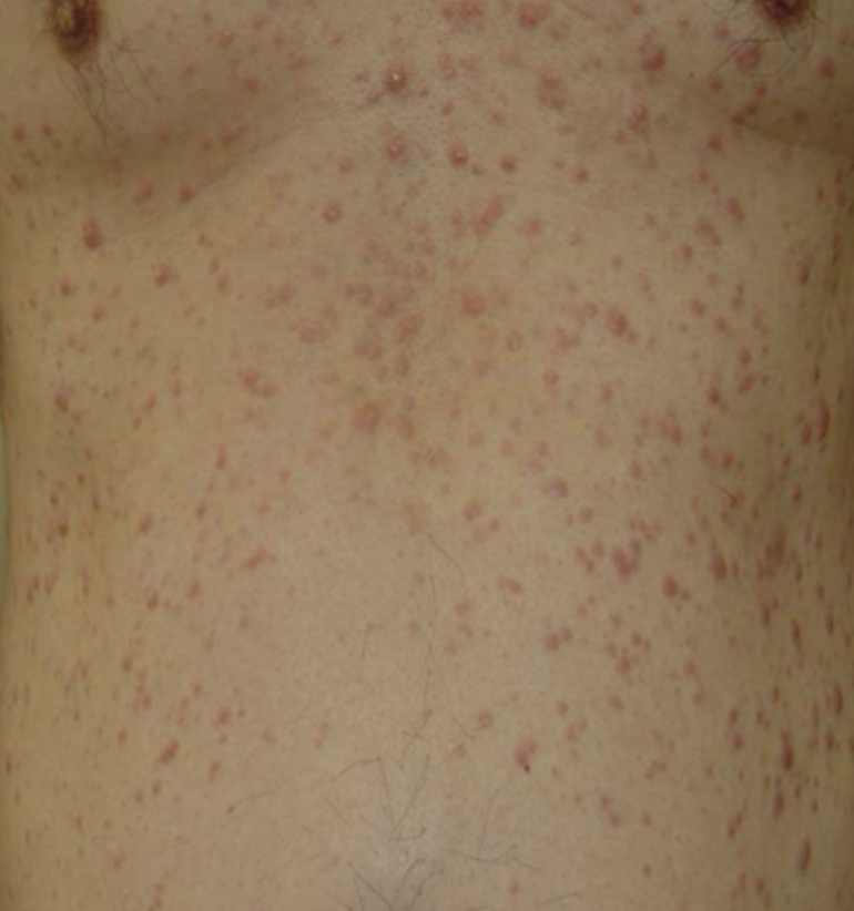 <p>Flesh-colored-to-violaceous papules, plaques, or nodules</p>