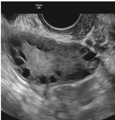 <ul><li><p>evaluating amenorrhea and oligomenorrhea</p></li><li><p>detecting PCOS appearance which indicates anovulation </p></li></ul>