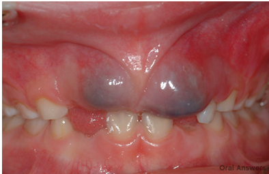 <p>-fluid accumulation within a follicular space of an erupting tooth</p><p>-no treatment needed</p><p>-will rupture on their own</p>