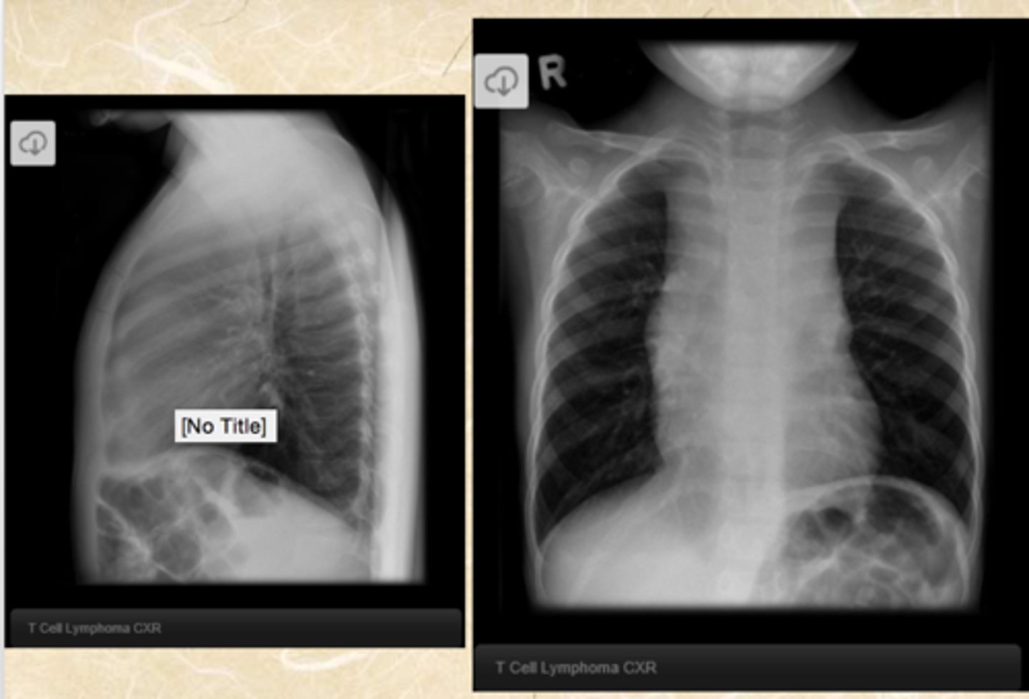 <p>What does this CXR show?</p>