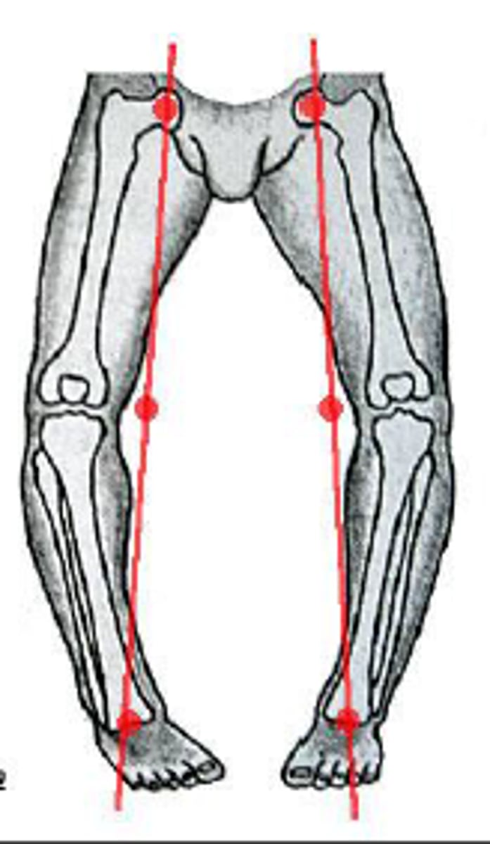 <p>bow-legged arch (outward bend)</p>