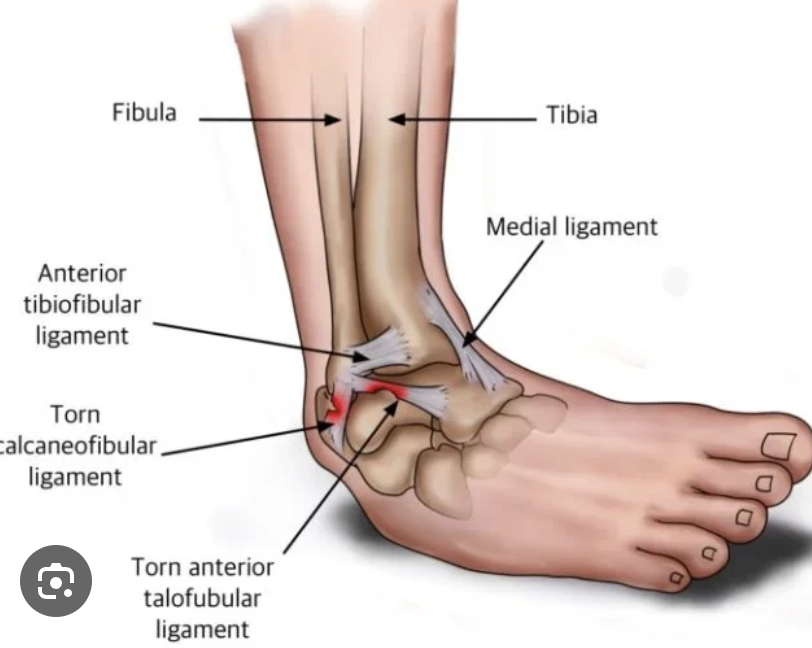 <p>anterior talofibular ligament  (inversion ankle sprains) </p>