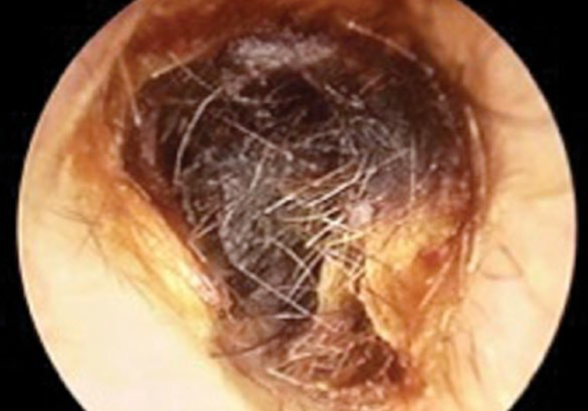 <p>Location: External Auditory Canal</p><ul><li><p>Ear wax</p><ul><li><p>Decrease in hearing</p></li></ul></li></ul><p></p>