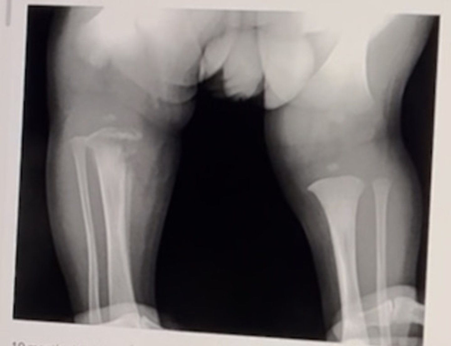 <p>osteomyelitis</p><p>3 multiple choice options</p>