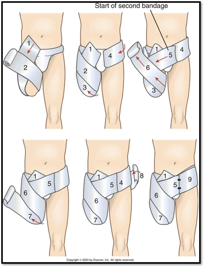 <p><span>•An amputation is the removal of a body extremity by trauma or surgery</span></p><p><span>•</span></p><p><span>•</span><strong><u><span>Causes: </span></u></strong><span>PVD, atherosclerosis, vascular changes related to diabetes, trauma, tobacco</span></p><p><span>•</span></p><p><span>•</span><strong><u><span>Signs/Symptoms: </span></u></strong><span>peripheral neuropathy, ulcers, gangrene, trauma, thermal injuries, tumors, congenital limb disorders.</span></p><p><span>•</span></p><p><span>•</span><strong><u><span>Diagnostics: </span></u></strong><span>H&amp;P, Vascular test,&nbsp; CBC with differential</span></p><p><span>•</span></p><p><span>•</span><strong><u><span>Goals: </span></u></strong><span>save extremity and remove infected or ischemic tissue</span></p><p><span>•</span></p><p><span>•</span><strong><u><span>Types of Amputations: </span></u></strong><span>Closed limb, Disarticulation, Syme’s</span></p>