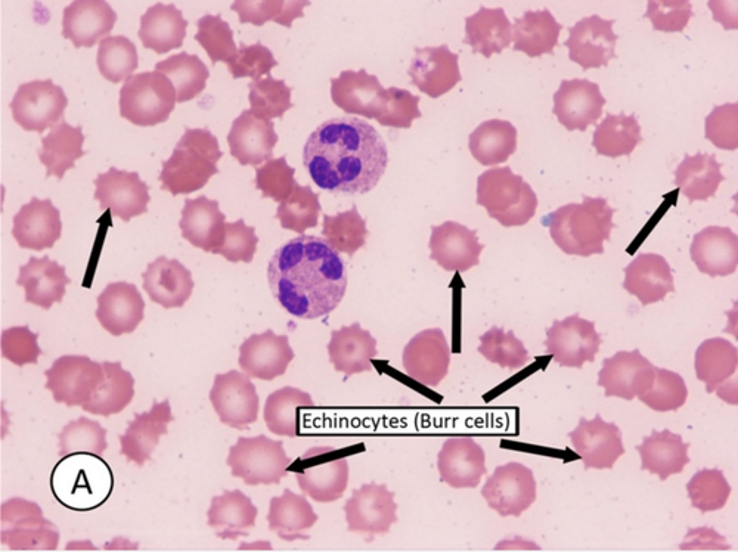 <p>-also known as echinocytes are spiculated appearing red blood cells with serrated edges that can be seen in liver disease and end stage renal disease.</p><p>-However burr cells are less common in the acute kidney injury seen in sclerderma</p>