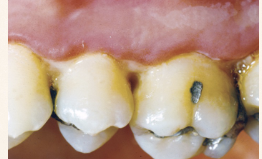 <p>Describe the tissue contour in this image?</p>