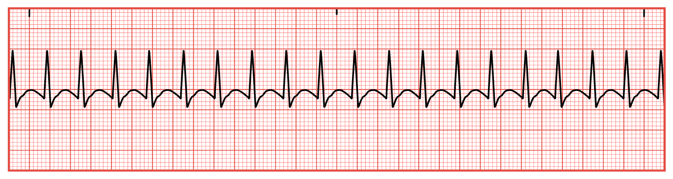 <p><strong><em>Can’t measure a PR interval</em></strong></p><p class="MsoNormal"><strong><em>QRS is skinny</em></strong></p><ul><li><p class="MsoNormal">Manifestations may present suddenly</p></li><li><p class="MsoNormal">Dizziness</p></li><li><p class="MsoNormal">Lightheadedness</p></li><li><p class="MsoNormal">Syncopal episodes</p></li><li><p class="MsoNormal">Hypotension</p></li><li><p class="MsoNormal">Shortness of breath</p></li><li><p class="MsoNormal">Palpitations</p></li><li><p class="MsoNormal">Increased risk of falls</p></li></ul><p>Vagal maneuvers</p><p class="MsoNormal">IV adenosine 6 mg IV over 1 to 3 seconds then flush with 20 mL NS</p><ul><li><p class="MsoNormal">If no change give a repeat dose of 12 mg followed by 20 mL NS</p></li><li><p class="MsoNormal">Adenosine will the heart rate: have a defibrillator on hand</p></li></ul><p></p>