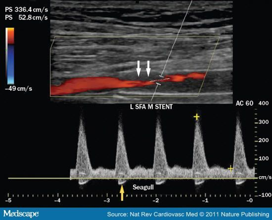 <p>Patient s/p angioplasty with stent x 4 years with reintervention x 2</p><p>Patient presents with symptoms of LT calf pain after walking 2 blocks.</p><p>ABI LT = .6 and ABI RT = .9</p><p>This is your image SFA stent.</p><p>Consider velocities</p><p>1.What additional information is necessary to calculate the inflow velocity ratio?</p><p>2.Is this PSV abnormal?</p><p>3.Does this finding explain patient symptoms?</p><p>4.Does this finding explain results of ABI?</p><p>5.What about angle? How would you improve?</p>