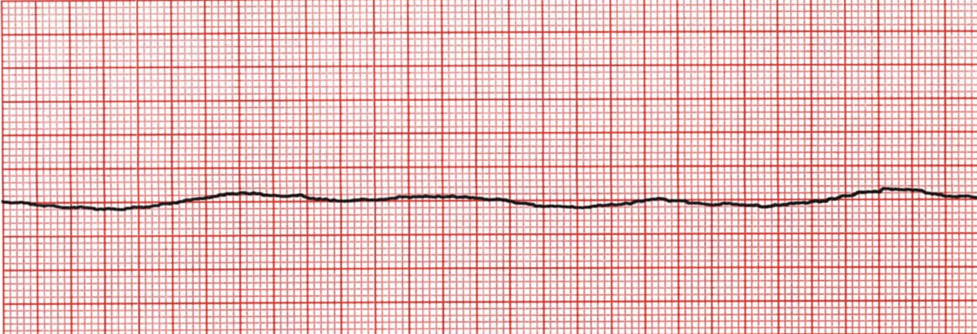 <p>what rhythm is shown in the ECG?</p>