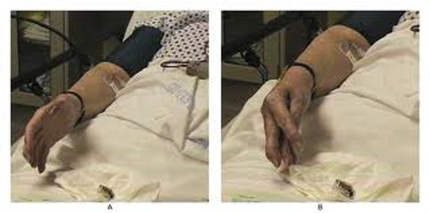 <p>A sign of hypocalcemia . Carpal spasm caused by inflating a blood pressure cuff above the client's systolic pressure and leaving it in place for 3 minutes.</p>