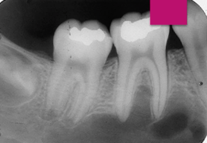 <p><strong>scalloping</strong> radiolucency around VITAL teeth, <strong>EMPTY CAVITY</strong> </p>