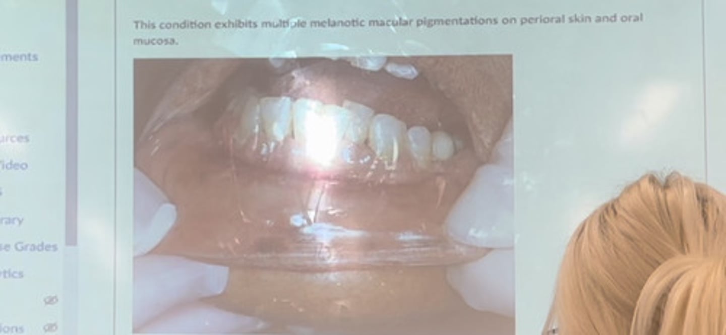 <p>The condition exhibits multiple melanotic macular pigmentations on perioral skin and oral mucosa</p>