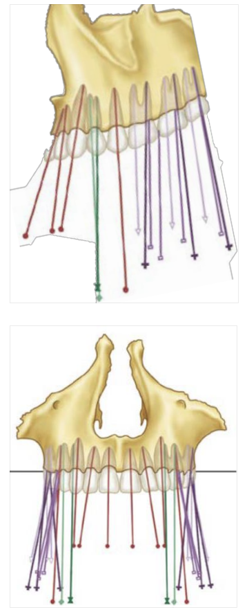 <p>Anterior mesially, most posterior distally/buccally inclined</p>