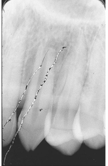 <p>What is the problem with this SCRATCHED FILM X-ray?</p>