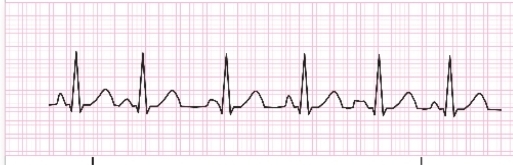 <ul><li><p>Pacemaker moves from the SA node to various areas within the atria.</p></li><li><p>Rhythm is slightly irregular.</p></li><li><p>Patients with significant lung disease</p></li><li><p>Treatment is usually not indicated.</p></li></ul><p></p>
