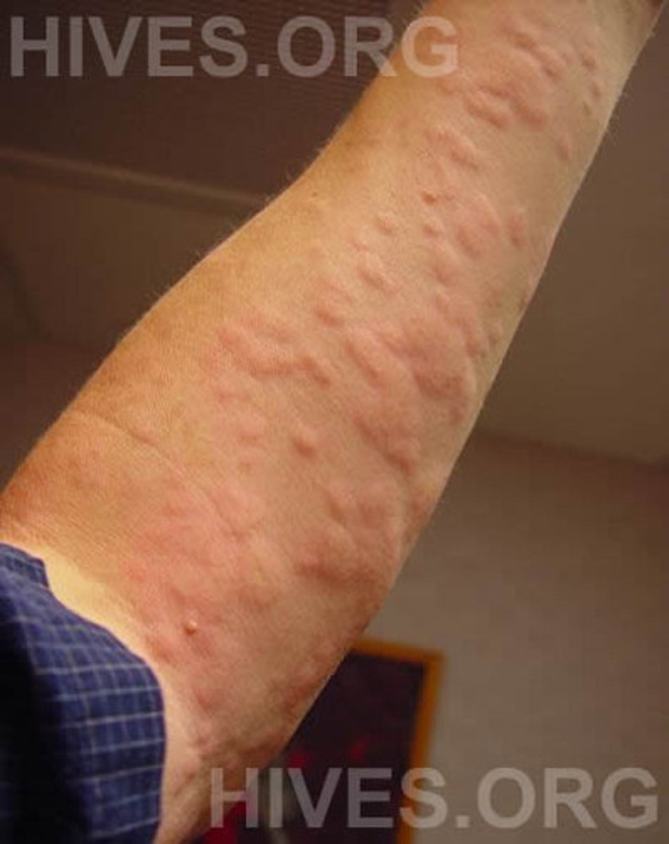 <p>allergic reaction of the skin characterized by eruption of pale-red elevated patches that are intensely itchy, also called wheals or hives</p>
