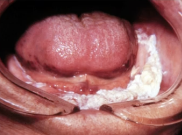 <p>What is another name for Verrucous Carcinoma?</p>