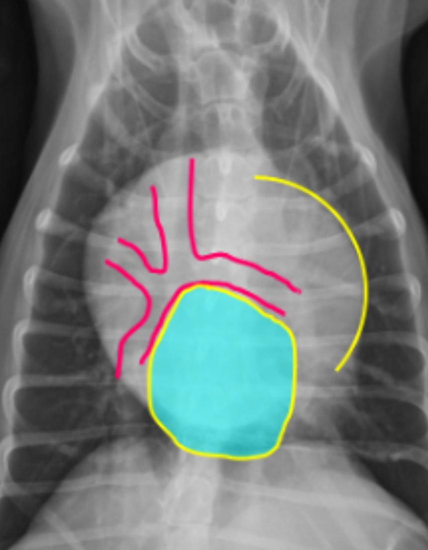 <p>-double opacity sign</p><p>-separation of main stem bronchi</p><p>-LA bulge at 2:30-3 o’clock</p>