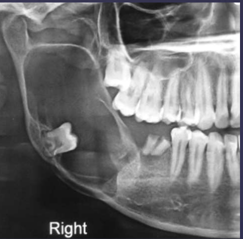 <p>describe what’s occurring in this radiograph </p>