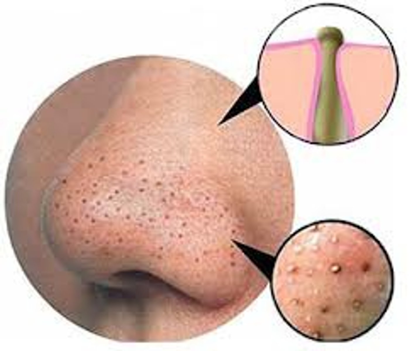 <p>a non-inflamed build up of cells, sebum and other debris inside follicles</p>